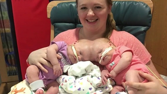 North Carolina Conjoined Twins Safely Separated 